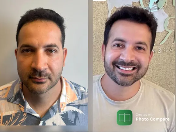 Antes e depois transplante capilar FUE - Paciente 1