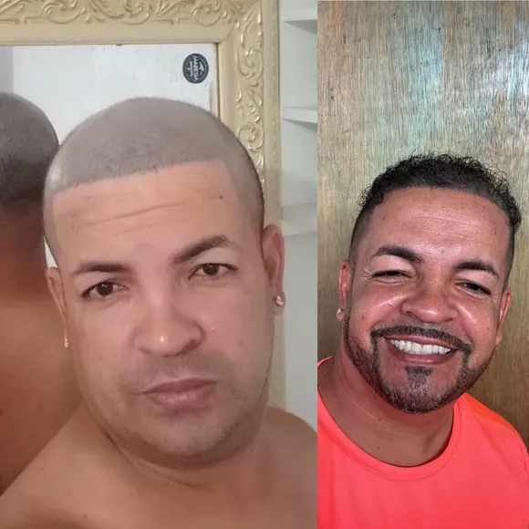 Antes e depois transplante capilar FUE - Paciente 5