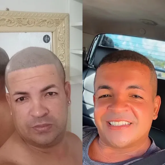 Antes e depois transplante capilar FUE - Paciente 8